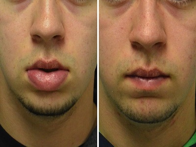 Lip Reduction Treatment